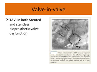Valve-in-valve
 TAVI in both Stented
  and stentless
  bioprosthetic valve
  dysfunction
 