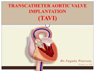 TRANSCATHETER AORTIC VALVE
IMPLANTATION
(TAVI)
Dr.Nagula Praveen,
F i n a l y r P G
 