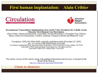 First human implantation: Alain Cribier
April 16, 2002 ( France)
Bovine pericardium valve
23mm in diameter
 