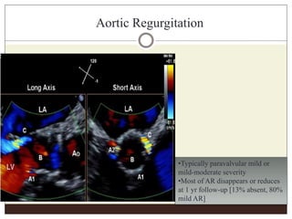Aortic Regurgitation
•Typically paravalvular mild or
mild-moderate severity
•Most of AR disappears or reduces
at 1 yr follow-up [13% absent, 80%
mild AR]
 