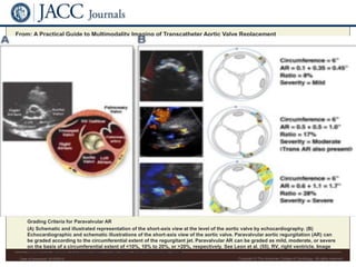 Date of download: 9/15/2015 Copyright © The American College of Cardiology. All rights reserved.
From: A Practical Guide to Multimodality Imaging of Transcatheter Aortic Valve Replacement
J Am Coll Cardiol Img. 2012;5(4):441-455. doi:10.1016/j.jcmg.2011.12.013
Grading Criteria for Paravalvular AR
(A) Schematic and illustrated representation of the short-axis view at the level of the aortic valve by echocardiography. (B)
Echocardiographic and schematic illustrations of the short-axis view of the aortic valve. Paravalvular aortic regurgitation (AR) can
be graded according to the circumferential extent of the regurgitant jet. Paravalvular AR can be graded as mild, moderate, or severe
on the basis of a circumferential extent of <10%, 10% to 20%, or >20%, respectively. See Leon et al. (55). RV, right ventricle. Image
credit: CC Patrick J. Lynch and C. Carl Jaffe, Yale University, 2006.
Figure Legend:
 