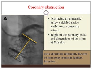 Coronary obstruction
 Displacing an unusually
bulky, calcified native
leaflet over a coronary
ostium
 height of the coronary ostia,
and dimensions of the sinus
of Valsalva.
ostia should be minimally located
14 mm away from the leaflets
insertion.
 
