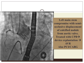 Left main stem
compromise with semi-
occlusive displacement
of calcified nodule
from aortic valve.
Treated with CPB
device explantation 
AVR
Also PCI/CABG
 
