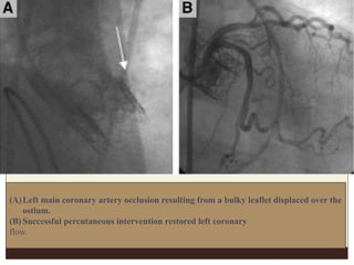 (A)Left main coronary artery occlusion resulting from a bulky leaflet displaced over the
ostium.
(B) Successful percutaneous intervention restored left coronary
flow.
 
