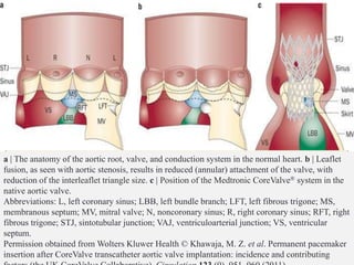 Conduction system disturbances
 Latent and manifest conduction disease in the bundle of His
and the tri fascicular conduction system.
 More extensive with calcified valves and greater valve
obstruction.
 Location of the AV node and origin of the left bundle adjacent
to the junction of the RCC and NCC, irritation of
membranous septum can affect AV conduction.
a | The anatomy of the aortic root, valve, and conduction system in the normal heart. b | Leaflet
fusion, as seen with aortic stenosis, results in reduced (annular) attachment of the valve, with
reduction of the interleaflet triangle size. c | Position of the Medtronic CoreValve® system in the
native aortic valve.
Abbreviations: L, left coronary sinus; LBB, left bundle branch; LFT, left fibrous trigone; MS,
membranous septum; MV, mitral valve; N, noncoronary sinus; R, right coronary sinus; RFT, right
fibrous trigone; STJ, sintotubular junction; VAJ, ventriculoarterial junction; VS, ventricular
septum.
Permission obtained from Wolters Kluwer Health © Khawaja, M. Z. et al. Permanent pacemaker
insertion after CoreValve transcatheter aortic valve implantation: incidence and contributing
 