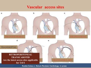 Vascular access sites
TRANSFEMORAL TRANSAPICAL TRANSAORTIC
TRANS SUBCLAVIAN TRANSAXILLARY
TRANSSEPTAL
RETROPERITONEAL
TRANSCAROTID
Are the latest access sites applicable
for TAVI
 