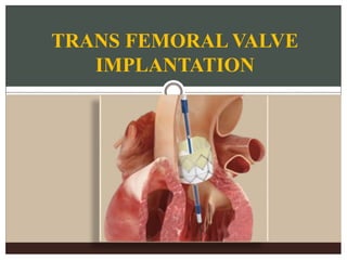 TRANS FEMORAL VALVE
IMPLANTATION
 