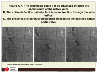 Figure 4. A, The prosthesis could not be advanced through the
commissure of the native valve.
B, The active deflection catheter facilitates redirection through the valve
orifice.
C, The prosthesis is carefully positioned adjacent to the calcified native
aortic valve.
John G. Webb et al. Circulation. 2006;113:842-850
Copyright © American Heart Association, Inc. All rights reserved.
 