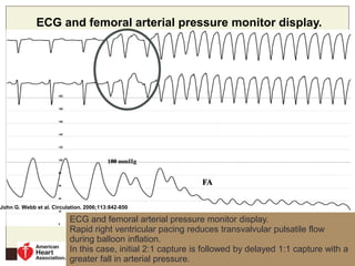 ECG and femoral arterial pressure monitor display.
John G. Webb et al. Circulation. 2006;113:842-850
Copyright © American Heart Association, Inc. All rights reserved.
ECG and femoral arterial pressure monitor display.
Rapid right ventricular pacing reduces transvalvular pulsatile flow
during balloon inflation.
In this case, initial 2:1 capture is followed by delayed 1:1 capture with a
greater fall in arterial pressure.
 