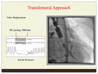 Transfemoral Approach
Valve Deployment
Aortic Pressure
RV pacing: 200/min
 