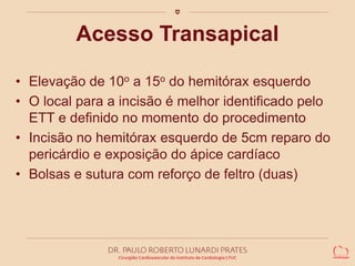 Acesso Transapical 
• Elevação de 10o a 15o do hemitórax esquerdo 
• O local para a incisão é melhor identificado pelo 
ETT e definido no momento do procedimento 
• Incisão no hemitórax esquerdo de 5cm reparo do 
pericárdio e exposição do ápice cardíaco 
• Bolsas e sutura com reforço de feltro (duas) 
 
