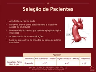 Seleção de Pacientes 
• Angulação da raiz da aorta 
• Distância entre o plano basal da aorta e o local do 
acesso ≥6 cm (figura) 
• Profundidade do campo que permita a palpação digital 
do acesso 
• Acesso aórtico livre se calcificações 
• Local do acesso livre de enxertos ou trajeto de artérias 
mamárias 
Approach 
Direct Aortic Left Subclavian / Axillary Right Subclavian / Axillary Iliofemoral 
Acceptable Aortic 
Root Angle* 
Any angle <70° <30° <70° 
 