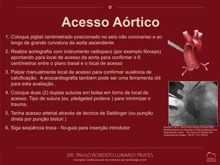 Acesso Aórtico 
Bruschi G, et al. Direct Aortic Access Through Right 
Minithoracotomy for Imlantation of Self-Expanding Aortic 
Bioprosthesis Valves . The Journal of Thoracic and 
Cardiovascular Surgery. 140 (3): 715-7 (2010). 
1. Coloque pigtail centimetrado posicionado no seio não coronariao e ao 
longo de grande curvatura da aorta ascendente 
2. Realize aortografia com instrumento radiopaco (por exemplo fórceps) 
apontando para local de acesso da aorta para confirmar ≥ 6 
centímetros entre o plano basal e o local de acesso 
3. Palpar manualmente local de acesso para confirmar ausência de 
calcificação. A ecocardiografia também pode ser uma ferramenta útil 
para esta avaliação . 
4. Coloque duas (2) duplas suturas em bolsa em torno de local de 
acesso. Tipo de sutura (ex. pledgeted prolene ) para minimizar o 
trauma. 
5. Tenha acesso arterial através de técnica de Seldinger (ou punção 
direta por punção bisturi ) 
6. Siga seqüência troca - fio-guia para inserção introdutor 
 