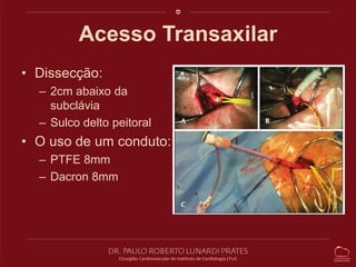 Acesso Transaxilar 
• Dissecção: 
– 2cm abaixo da 
subclávia 
– Sulco delto peitoral 
• O uso de um conduto: 
– PTFE 8mm 
– Dacron 8mm 
 
