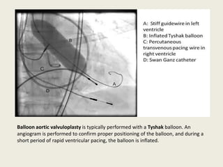 Balloon aortic valvuloplasty is typically performed with a Tyshak balloon. An
angiogram is performed to confirm proper positioning of the balloon, and during a
short period of rapid ventricular pacing, the balloon is inflated.
 