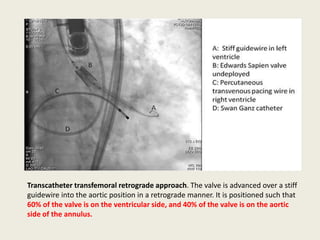 Transcatheter transfemoral retrograde approach. The valve is advanced over a stiff
guidewire into the aortic position in a retrograde manner. It is positioned such that
60% of the valve is on the ventricular side, and 40% of the valve is on the aortic
side of the annulus.
 