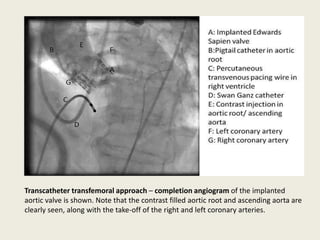 Transcatheter transfemoral approach – completion angiogram of the implanted
aortic valve is shown. Note that the contrast filled aortic root and ascending aorta are
clearly seen, along with the take-off of the right and left coronary arteries.
 