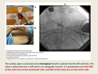 The cardiac apex is accessed and a transapical sheath is placed into the left ventricle. The
valve is advanced over a stiff wire in an antegrade manner. It is positioned such that 50%
of the valve lies on the ventricular side, and 50% of the valve lies on the aortic side.
 