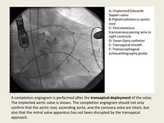 A completion angiogram is performed after the transapical deployment of the valve.
The implanted aortic valve is shown. The completion angiogram should not only
confirm that the aortic root, ascending aorta, and the coronary ostia are intact, but
also that the mitral valve apparatus has not been disrupted by the transapical
approach.
 
