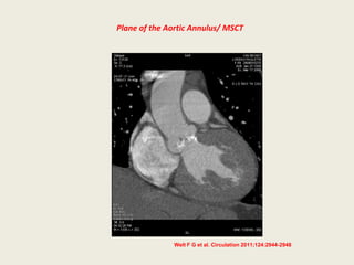 Plane of the Aortic Annulus/ MSCT




              Welt F G et al. Circulation 2011;124:2944-2948
 