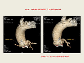 MSCT :Distance Annulus /Coronary Ostia




                 Welt F G et al. Circulation 2011;124:2944-2948
 