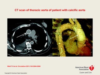 CT scan of thoracic aorta of patient with calcific aorta




    Welt F G et al. Circulation 2011;124:2944-2948



Copyright © American Heart Association
 