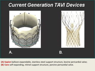 (A) Sapien balloon-expandable, stainless steel support structure, bovine pericardial valve;
(B) Core self-expanding, nitinol support structure, porcine pericardial valve.
 