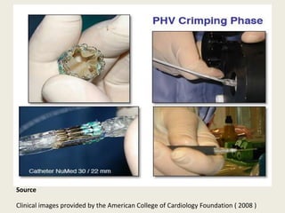 Source

Clinical images provided by the American College of Cardiology Foundation ( 2008 )
 