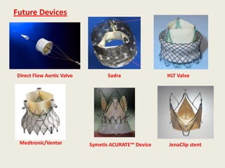 Future Devices




Direct Flow Aortic Valve         Sadra               HLT Valve




 Medtronic/Ventor          Symetis ACURATE™ Device   JenaClip stent
 
