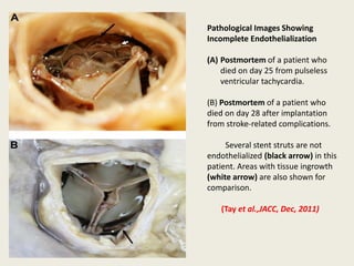 Pathological Images Showing
Incomplete Endothelialization

(A) Postmortem of a patient who
    died on day 25 from pulseless
    ventricular tachycardia.

(B) Postmortem of a patient who
died on day 28 after implantation
from stroke-related complications.

     Several stent struts are not
endothelialized (black arrow) in this
patient. Areas with tissue ingrowth
(white arrow) are also shown for
comparison.

    (Tay et al.,JACC, Dec, 2011)
 