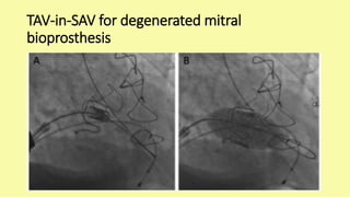 Tav Device TAVI - Transcatheter Aortic Valve Implantation | PPTX