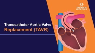 Transcatheter Aortic Valve
Replacement (TAVR)
 