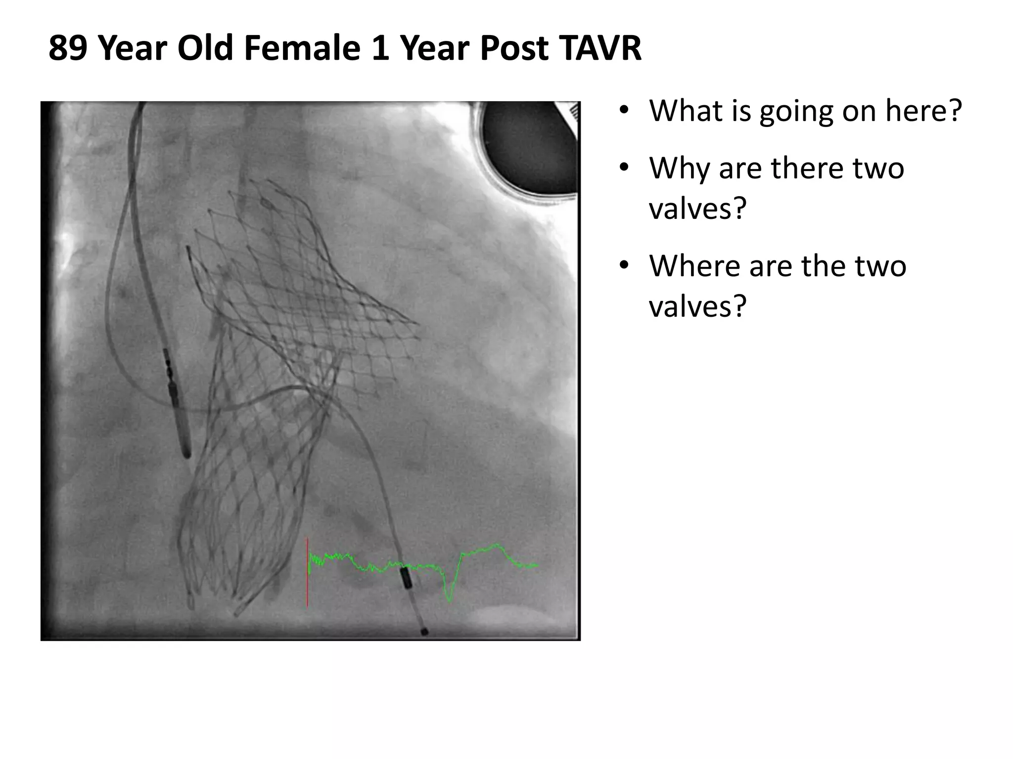 • What is going on here?
• Why are there two
valves?
• Where are the two
valves?
89 Year Old Female 1 Year Post TAVR
