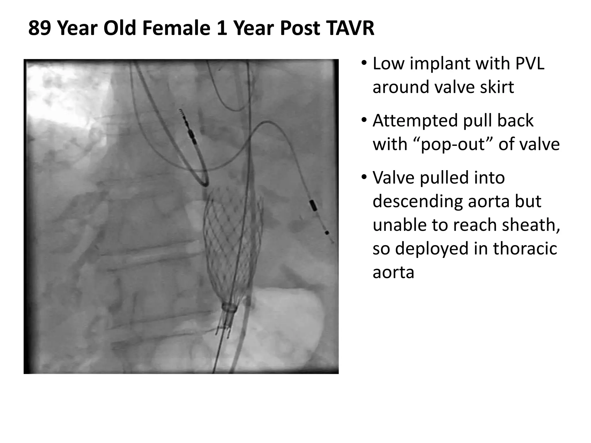 • Low implant with PVL
around valve skirt
• Attempted pull back
with “pop-out” of valve
• Valve pulled into
descending aorta but
unable to reach sheath,
so deployed in thoracic
aorta
89 Year Old Female 1 Year Post TAVR