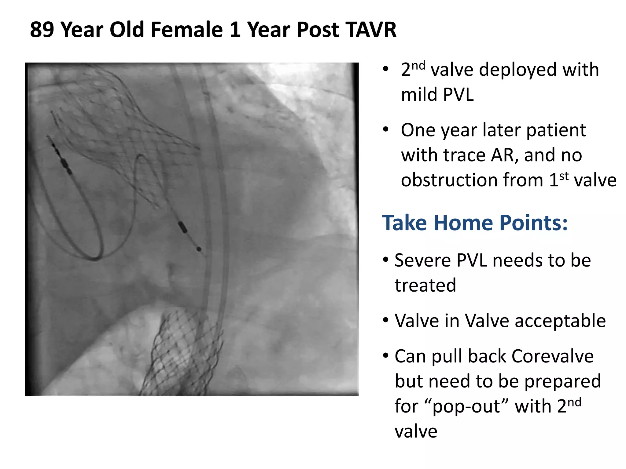 • 2nd valve deployed with
mild PVL
• One year later patient
with trace AR, and no
obstruction from 1st valve
Take Home Points:
• Severe PVL needs to be
treated
• Valve in Valve acceptable
• Can pull back Corevalve
but need to be prepared
for “pop-out” with 2nd
valve
89 Year Old Female 1 Year Post TAVR
