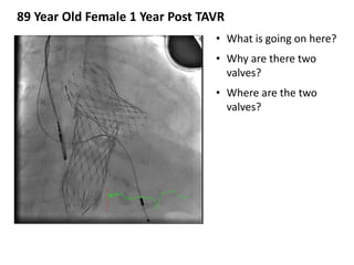• What is going on here?
• Why are there two
valves?
• Where are the two
valves?
89 Year Old Female 1 Year Post TAVR
 