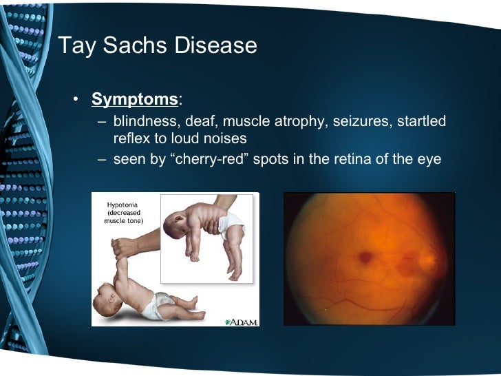 Tay Sachs