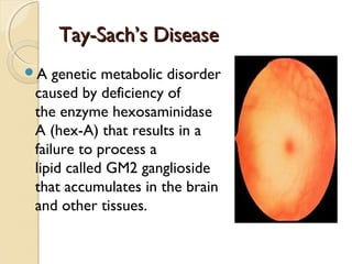 Tay-Sach’s Disease
A genetic metabolic disorder

caused by deficiency of
the enzyme hexosaminidase
A (hex-A) that results in a
failure to process a
lipid called GM2 ganglioside
that accumulates in the brain
and other tissues. 

 
