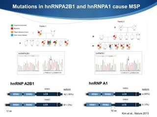 Mutations in hnRNPA2B1 and hnRNPA1 cause MSP
hnRNP A2B1
12 aa
D290V
D302V
A2 ( 95%)
B1 ( 5%)
isoform
LCS
LCS
MS9MS9
D262V
hnRNP A1
52 aa
a (95%)
b ( 5%)
isoform
LCS
LCS
MS9MS9
D262V
Kim et al., Nature 2013
 