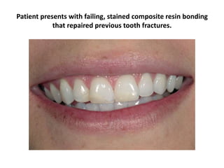 Patient presents with failing, stained composite resin bonding
that repaired previous tooth fractures.
 