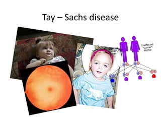 Tay – Sachs disease
 