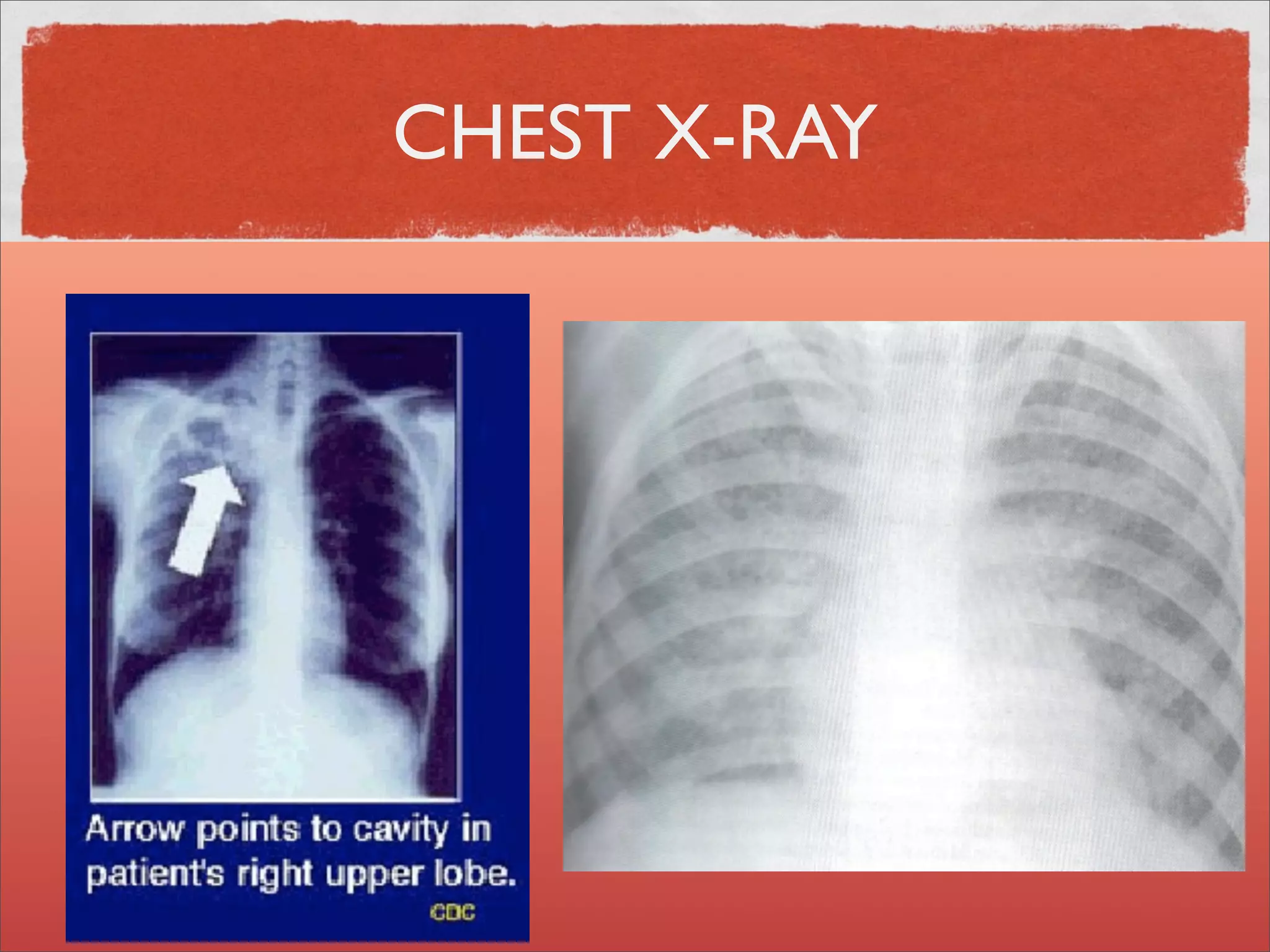 CHEST X-RAY
 