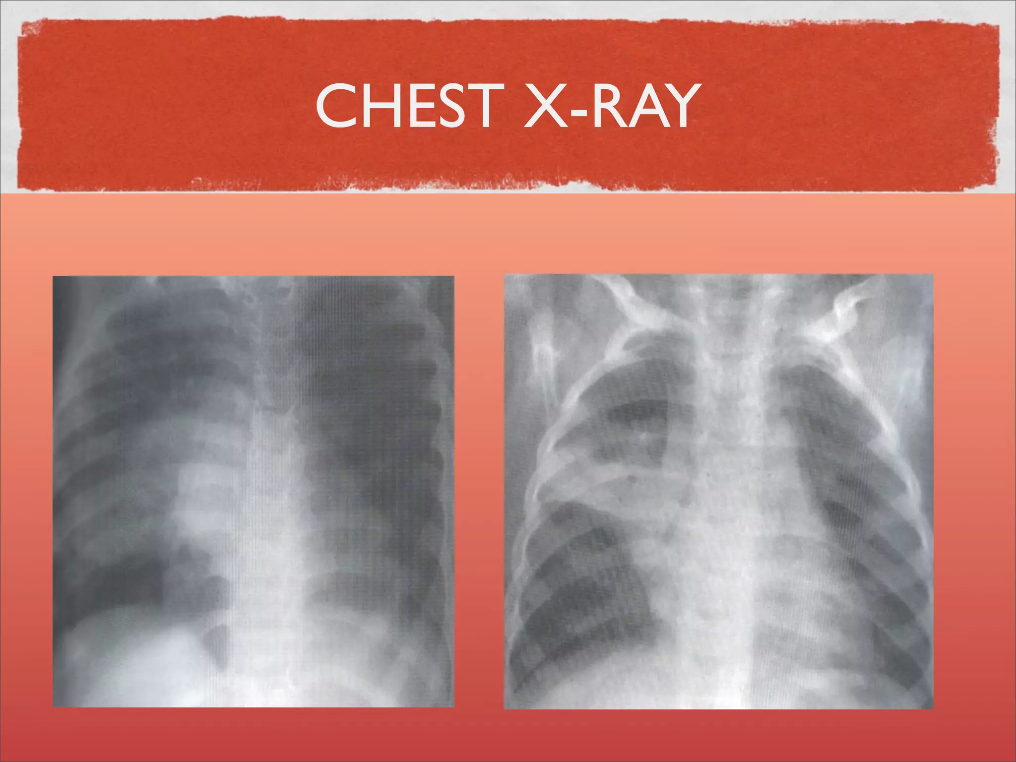CHEST X-RAY
 