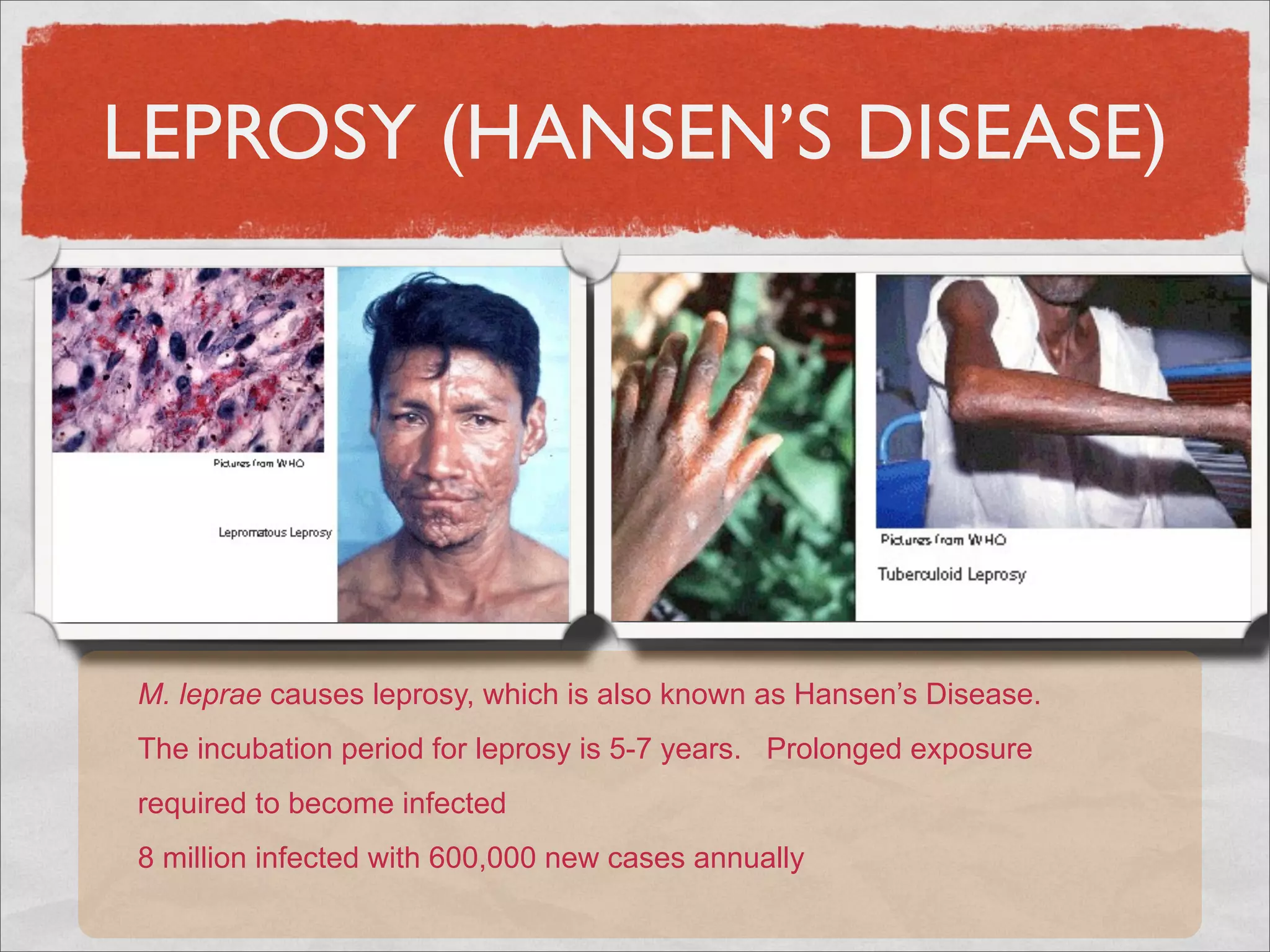 LEPROSY (HANSEN’S DISEASE)




M. leprae causes leprosy, which is also known as Hansen’s Disease.
The incubation period for leprosy is 5-7 years. Prolonged exposure
required to become infected
8 million infected with 600,000 new cases annually
 