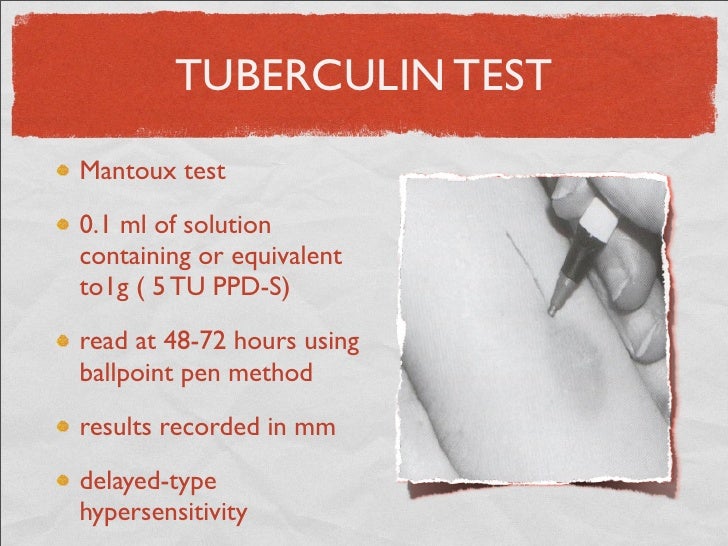Test Di Mantoux Dopo 12 Ore Arrossato
