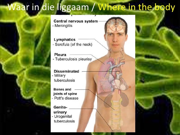 picture Tuberkulose Prente tb