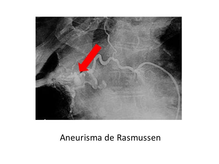 aneurisma de rasmussen