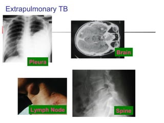Extrapulmonary TB
Pleura
Lymph Node
Brain
Spine
 