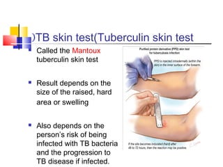 TB skin test(Tuberculin skin test(
 Called the Mantoux
tuberculin skin test
 Result depends on the
size of the raised, hard
area or swelling
 Also depends on the
person’s risk of being
infected with TB bacteria
and the progression to
TB disease if infected.
 