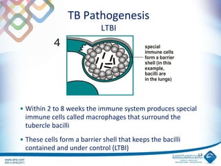 TB Pathogenesis
LTBI
17
special
immune cells
form a barrier
shell (in this
example,
bacilli are
in the lungs)
4
• Within 2 to 8 weeks the immune system produces special
immune cells called macrophages that surround the
tubercle bacilli
• These cells form a barrier shell that keeps the bacilli
contained and under control (LTBI)
 